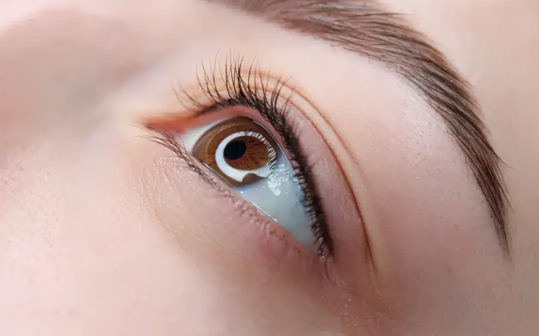 Wimpernkranzverdichtung