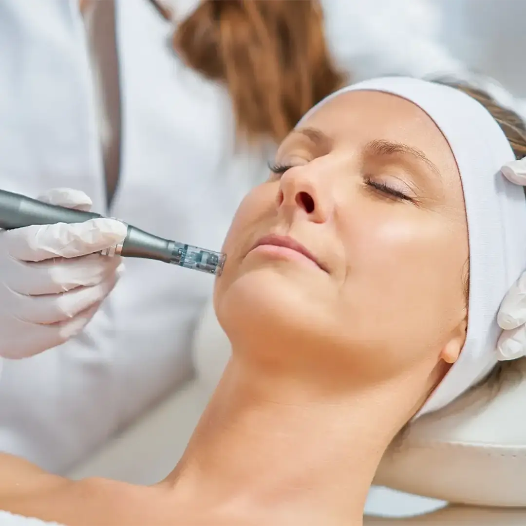 Black-Week: −20 % auf Micro-Needling Gutscheine