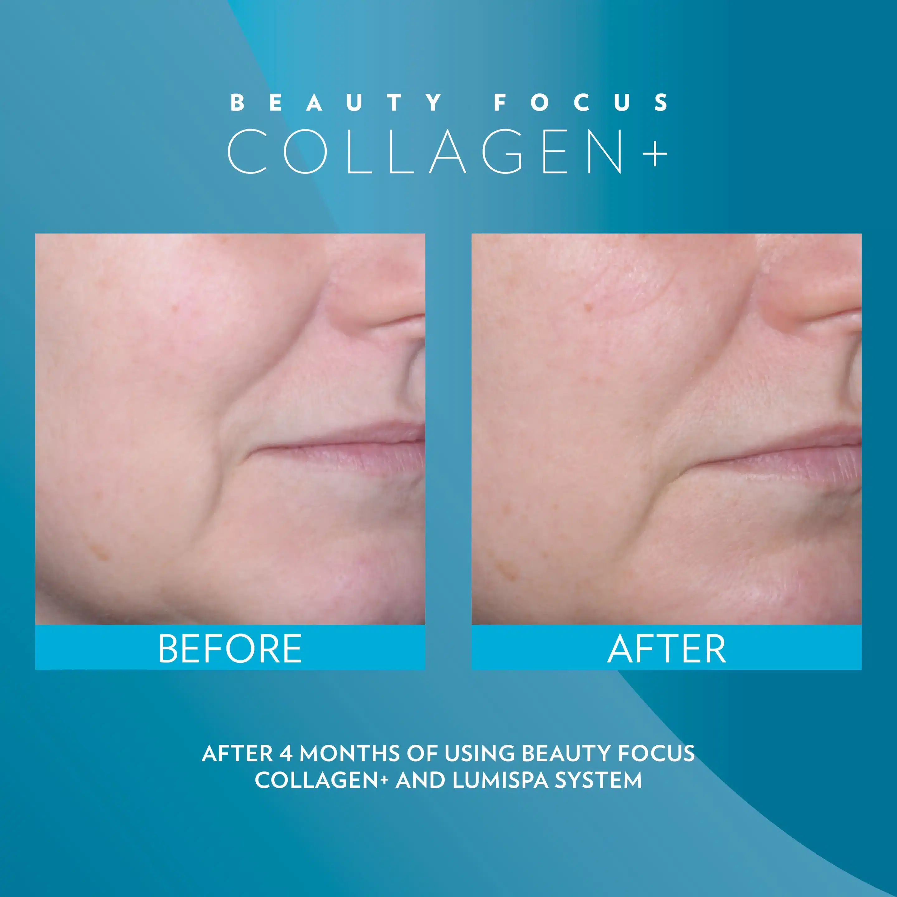 Before/After Beispiel: Hautbild nach 4 Monaten Beauty Focus Collagen+ und LumiSpa System – Ergebnisse individuell
