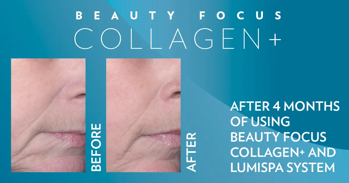 Before/After Beispiel (4 Monate): Beauty Focus Collagen+ und LumiSpa System – Ergebnisse individuell
